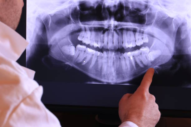 Best Emergency Tooth Extraction in Thompson Falls, MT